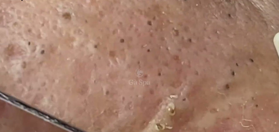 This What Your Remove Blackheads Should Popping