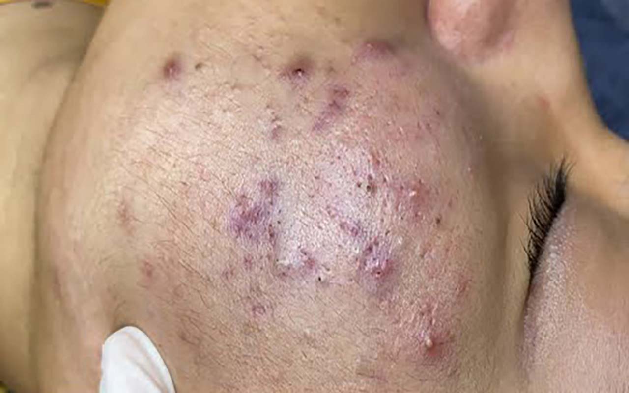 This What Your Remove Blackheads Should Popping